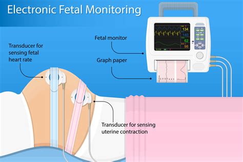 What Does Toco Mean on a Fetal Monitor: Exploring the Mysteries of Maternal-Fetal Monitoring